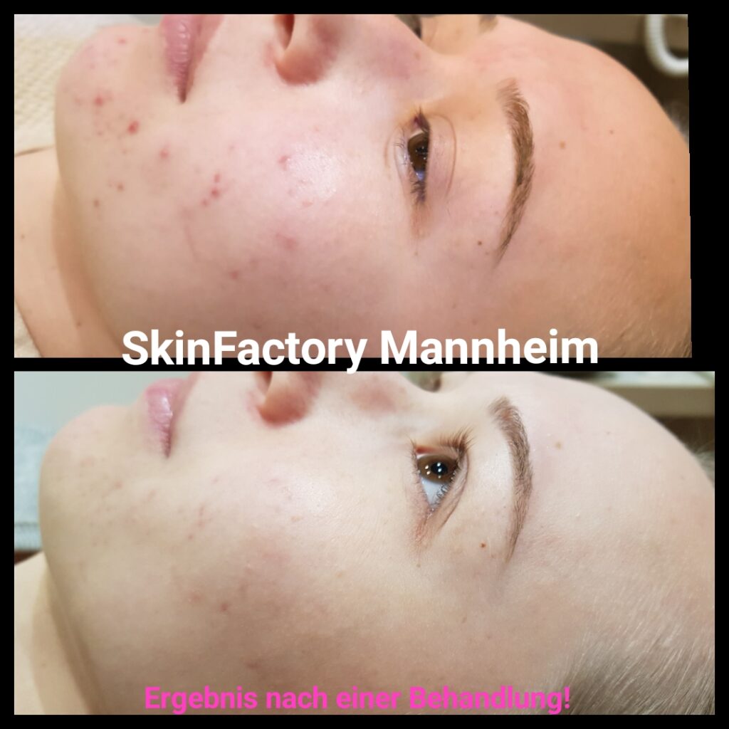 Vorher- / Nachher Bild eines Gesichtes nach einer Akne-Behandlung