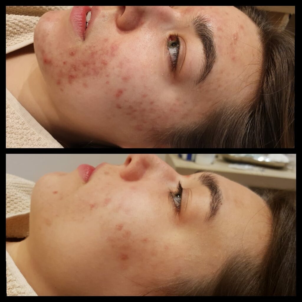 Vorher- / Nachher Bild eines Gesichtes nach einer Akne-Behandlung. Die Haut hat deutlich weniger Unreinheiten. 