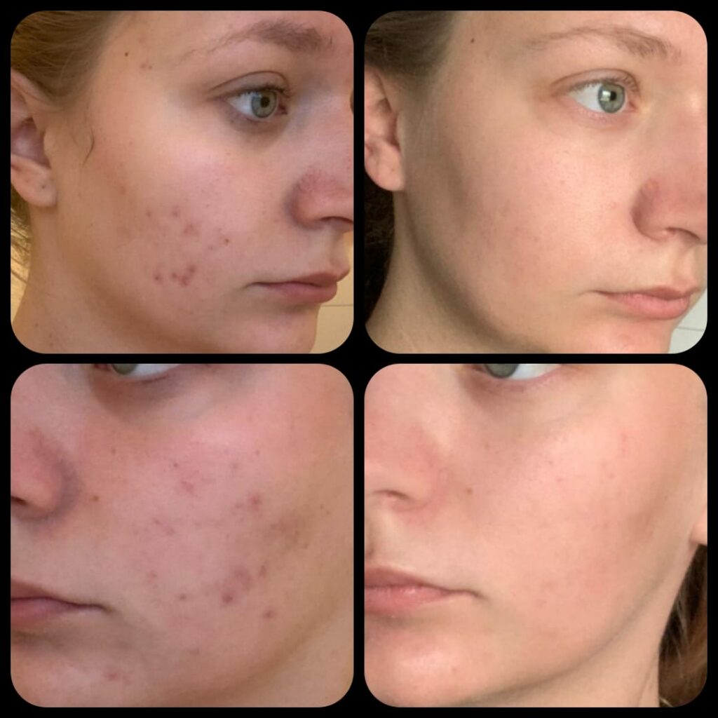 Vorher- / Nachher Bild eines Gesichtes nach einer Akne-Behandlung